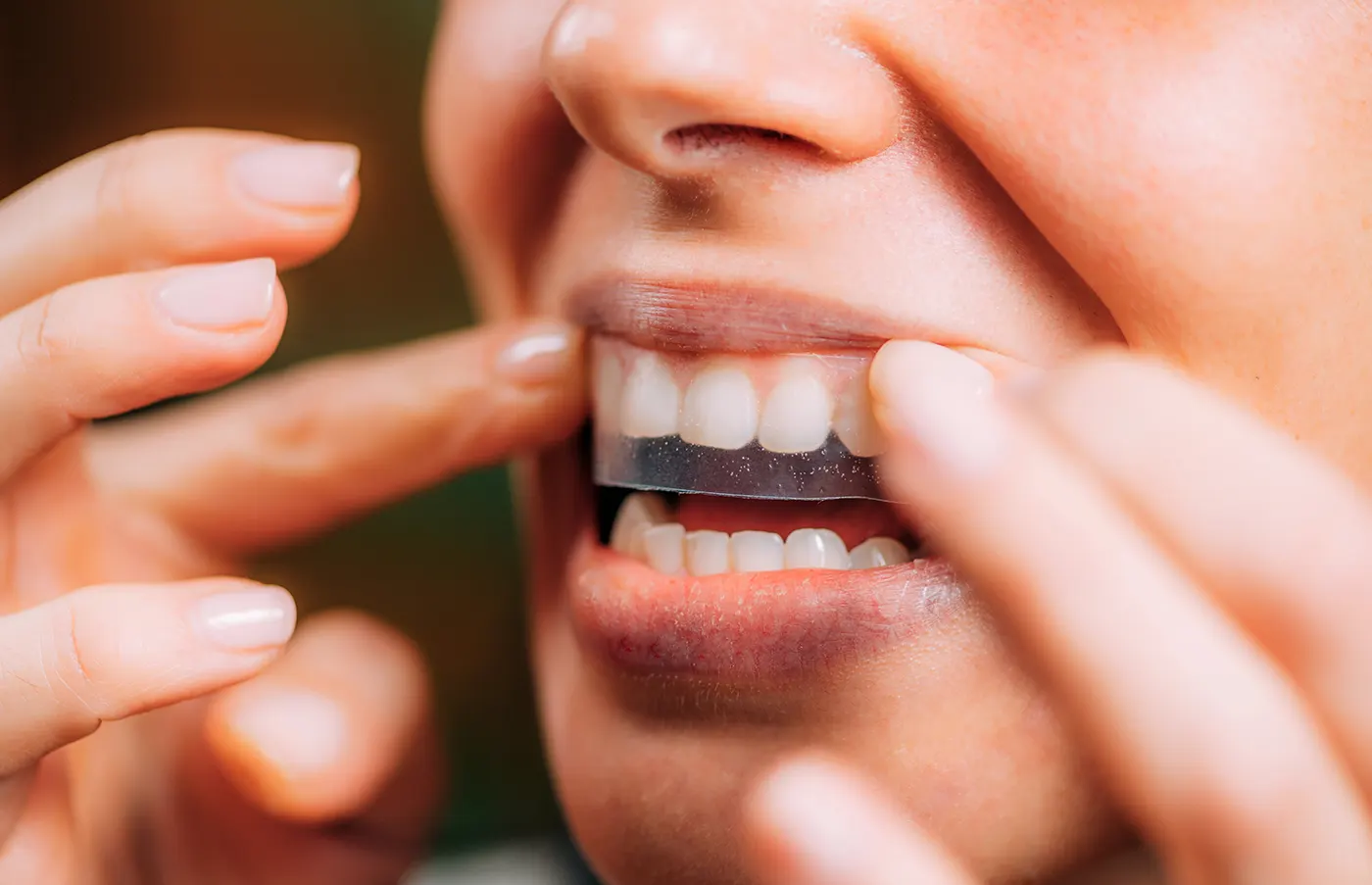 teeth whitening langley